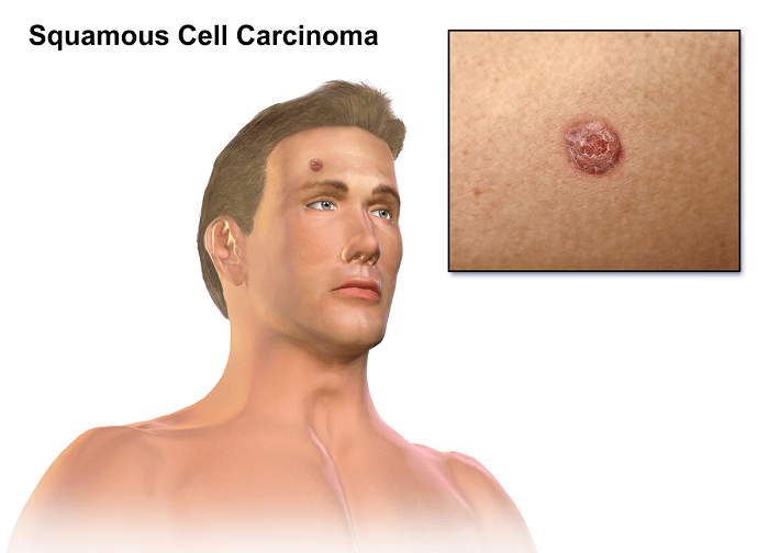 carcinoma as a skin cancer sign