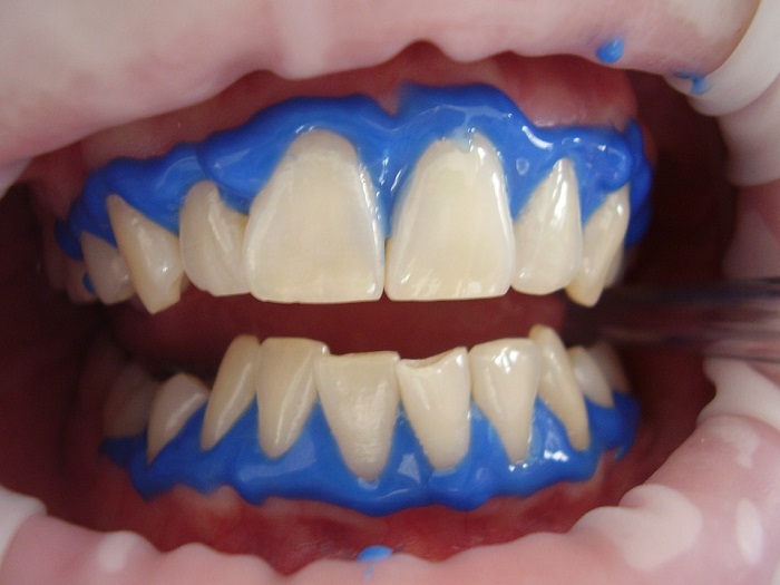 laser teeth whitening procedure