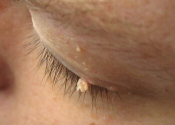skin tags