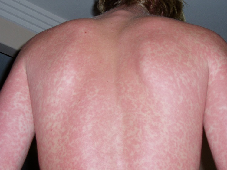 unusual skin rashes
