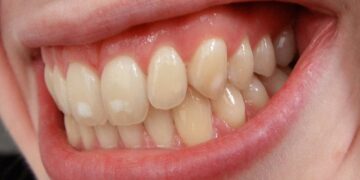 white spots on teeth