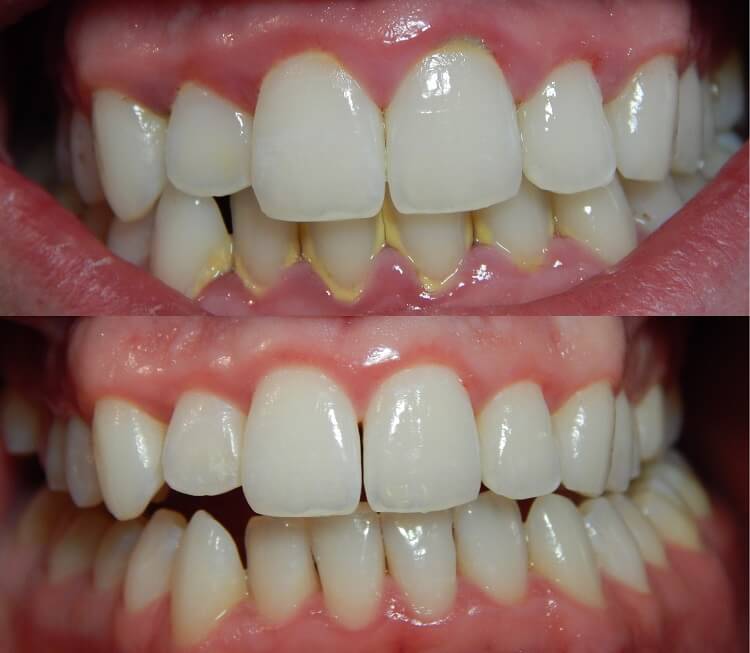 white teeth 2