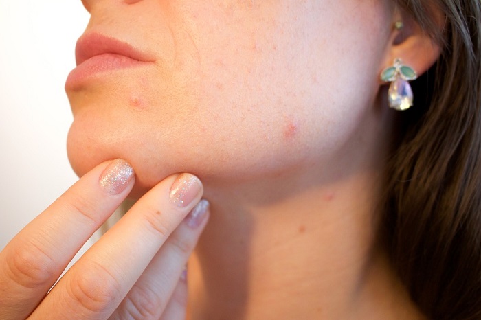 acne and skin conditions