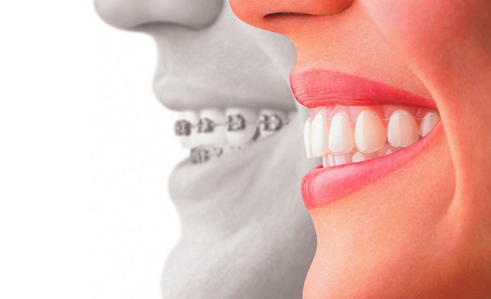 braces and other modern dental services
