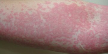 hives