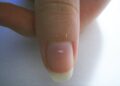 nails white spots