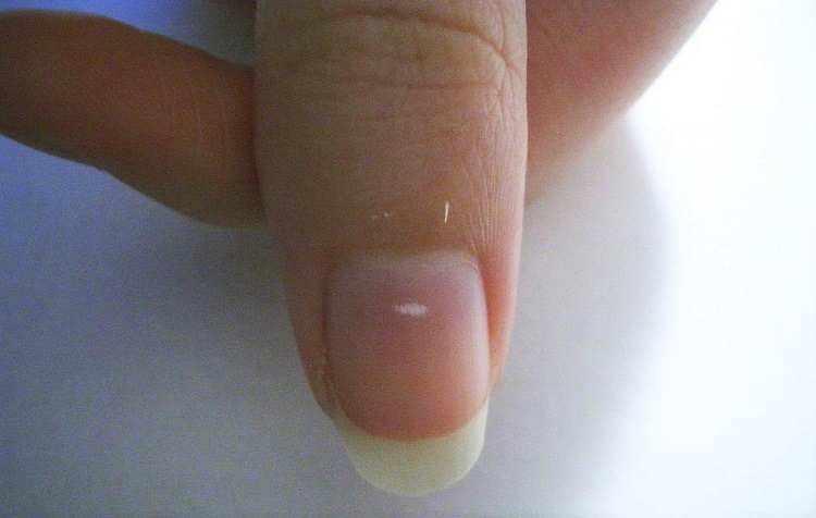 nails white spots