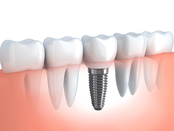 tooth implant 3D representation