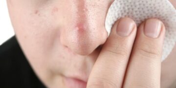 acne skin