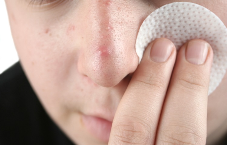 Why Managing Acne Is Vital for Long-Term Skincare