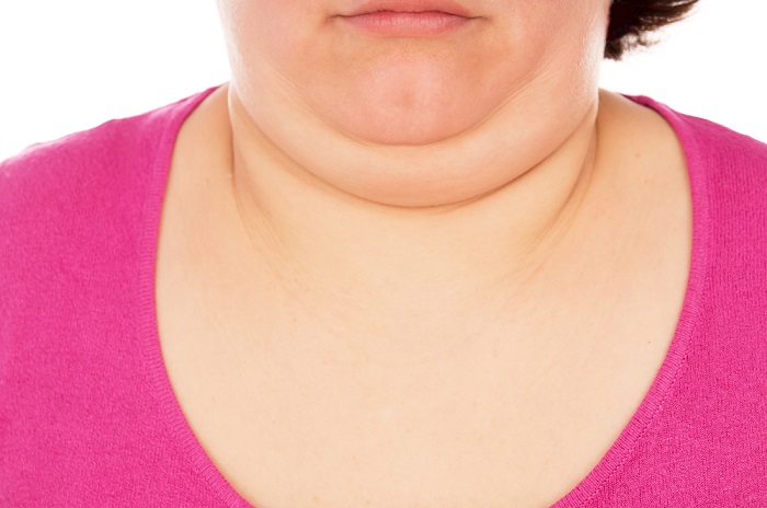 a middle aged woman needing a double chin removal treatment