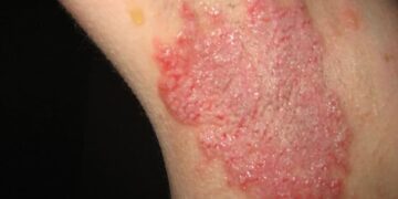 skin rash