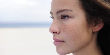 freckles