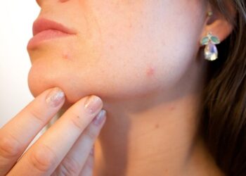 Tips to Get Rid of Acne