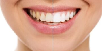 Extrinsic Teeth Stains