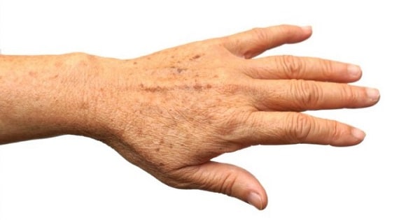 Age spots on a hand