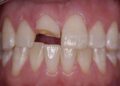 Chipped tooth e1499417858729