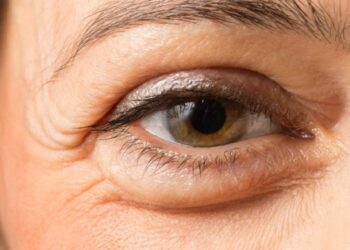 how to get rid of undereye bags - puffy eyes