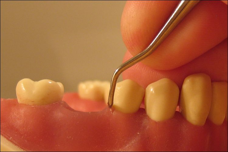Close up of a dentist's hand inspecting gums with a sharp metal tool