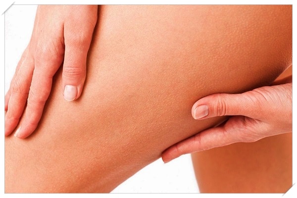 what is microneedling stretch marks