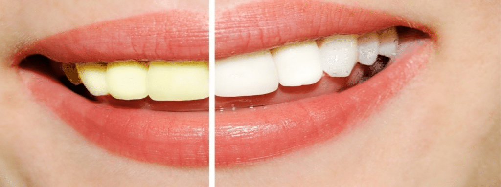 How Does Teeth Whitening Mouthwash Work?