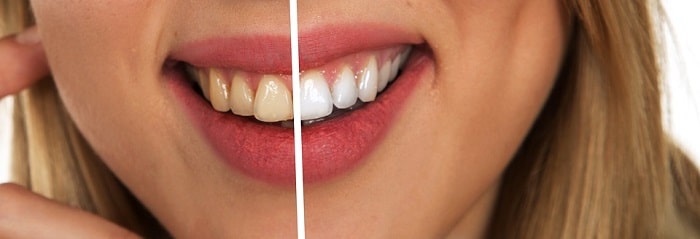 Learn How to Prevent Teeth Staining in 4 Easy Ways