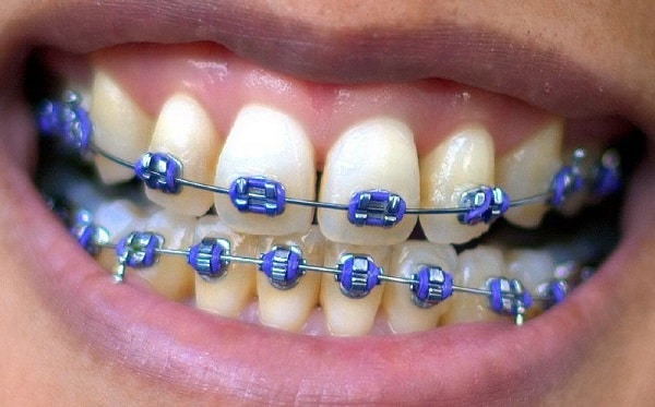 purple dental braces