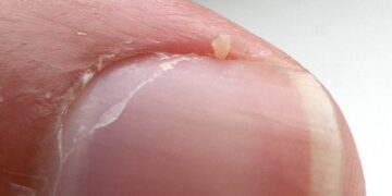 Daumennagel mit Nagelhaut und Niednagel