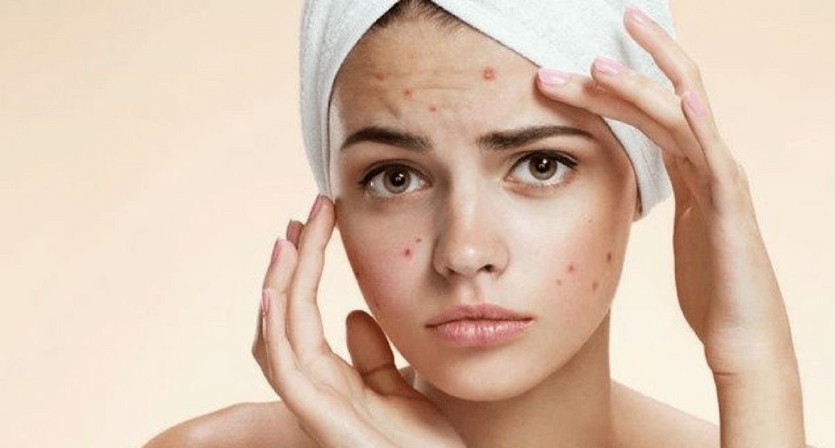 7 Habits Of Everyday Life To Avoid Getting Acne