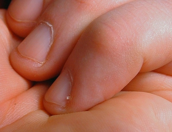hangnails on someone's hand