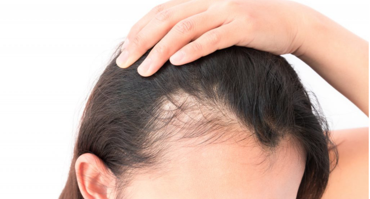 6 Proven Hair Loss Solutions To Help Restore Your Hair To Its Former Glory