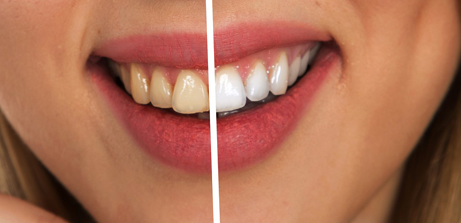 Top 10 Best Whitening Toothpaste Brands